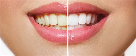 Can yellow teeth become white again?