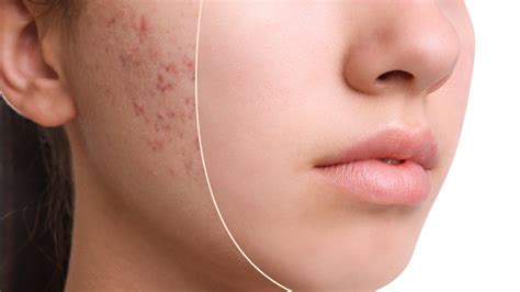 Can you 100% remove acne scars?
