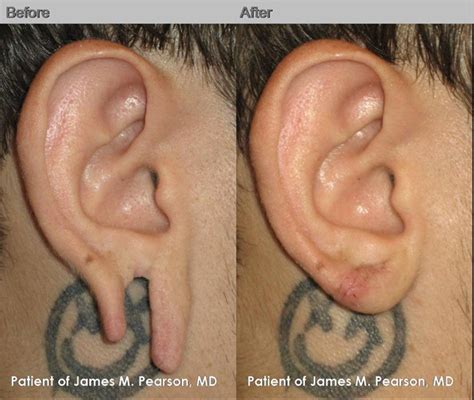 Can you Repierce a ripped earlobe?