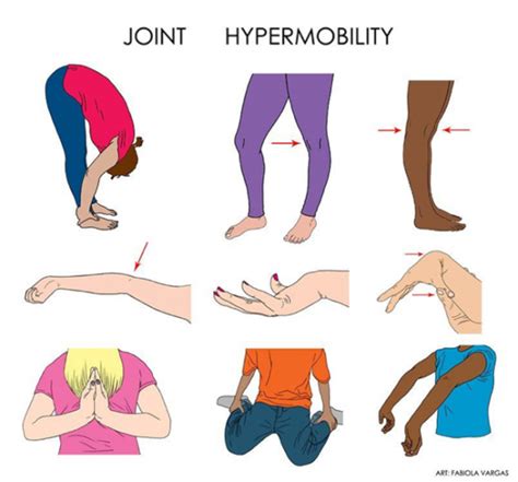 Can you be hypermobile and not flexible?