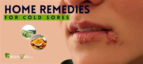 Can you be naturally immune to cold sores?