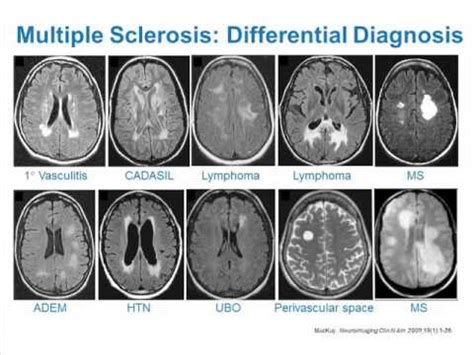 Can you be normal with MS?