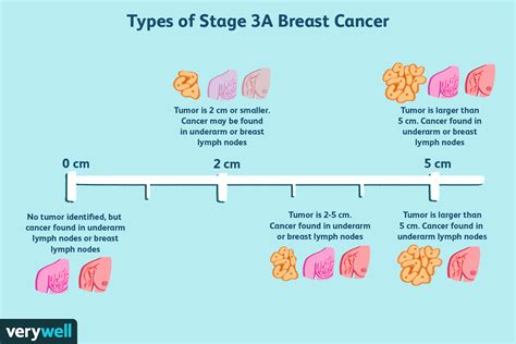 Can you beat Stage 3 cancer?