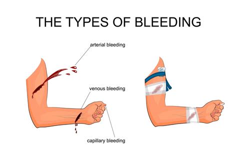 Can you bleed out if you hit a vein?