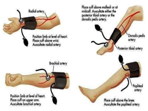 Can you check manual BP on forearm?