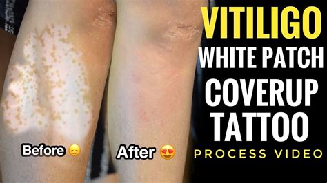 Can you cover white scars?