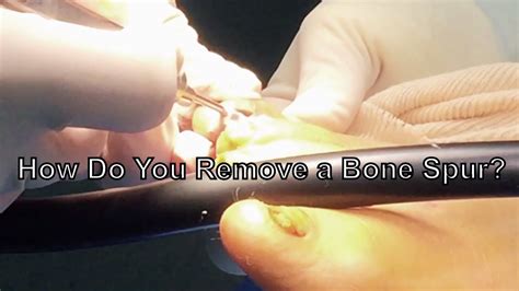 Can you cut off bone spurs?