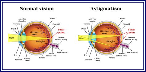 Can you develop astigmatism?