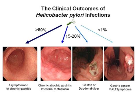 Can you diagnose an ulcer without an endoscopy?