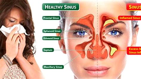 Can you drain sinuses with a needle?