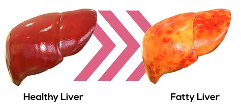 Can you ever drink again after fatty liver?