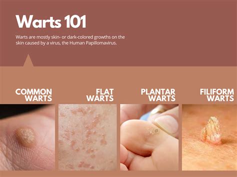 Can you ever fully get rid of genital warts?