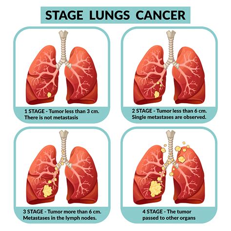 Can you feel Stage 1 lung cancer?