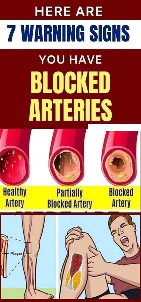 Can you feel a blocked artery?