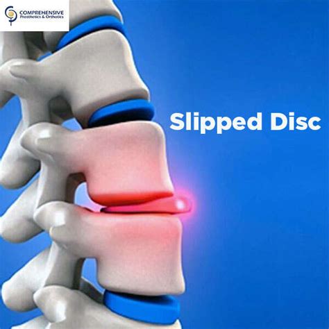 Can you feel a disc slip in your back?