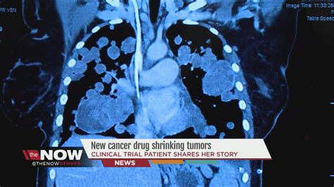 Can you feel a tumour shrinking?