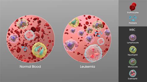 Can you feel normal with leukemia?
