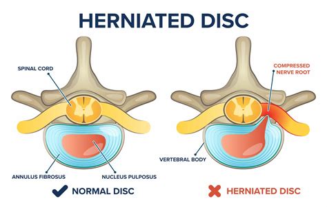 Can you feel when you herniate a disc?