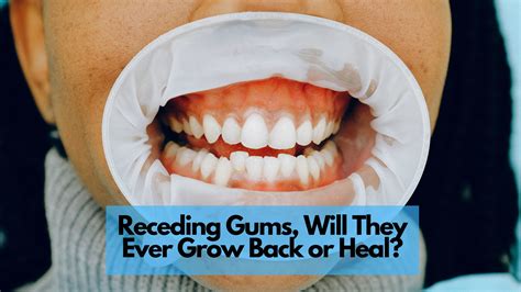 Can you feel your gums healing?