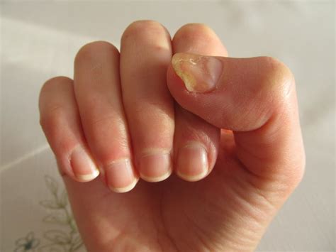Can you finger with a yeast infection?