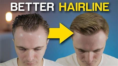 Can you fix a bad hairline?