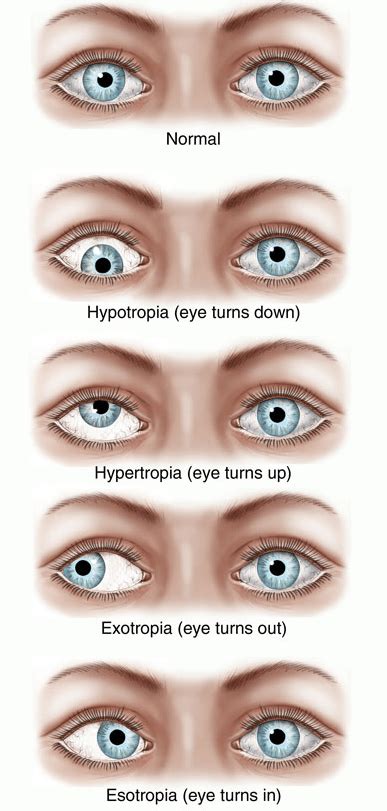 Can you fix a wandering eye in adults?