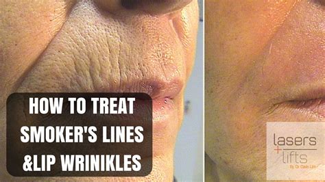 Can you fix smoker lips?