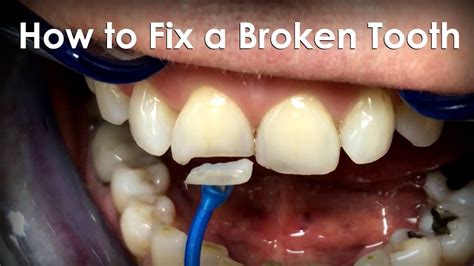 Can you fix teeth without dentist?