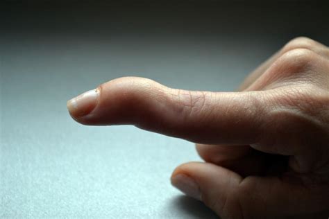 Can you fully bend a broken finger?