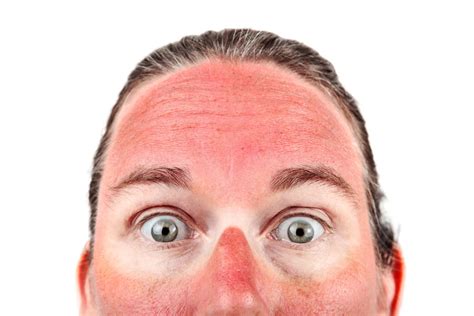 Can you get a facial with sunburn?