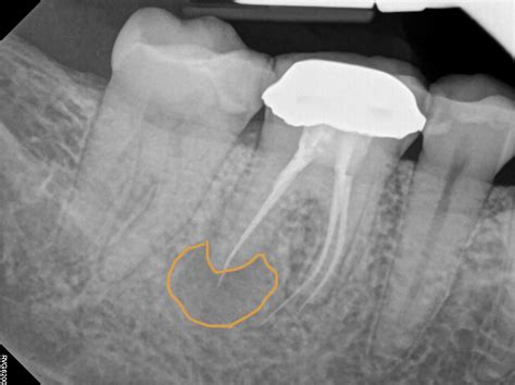 Can you get a refund for a bad root canal?