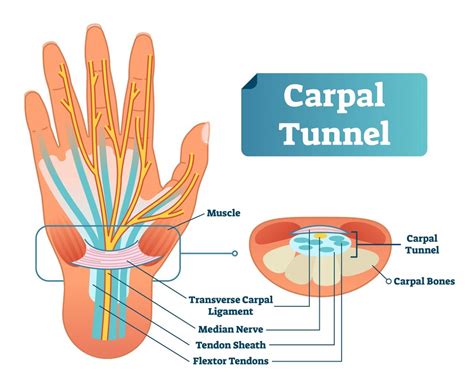 Can you get carpal tunnel twice?