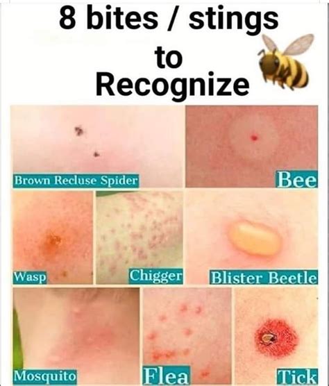 Can you get hives 2 weeks after bee sting?