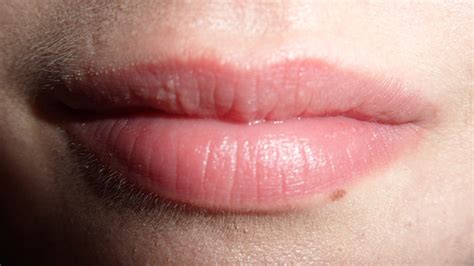 Can you get lie bumps from kissing?