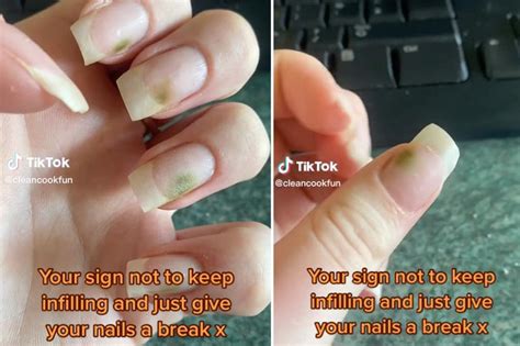 Can you get mold under acrylic nails?