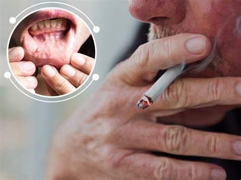 Can you get oral cancer without smoking or drinking?