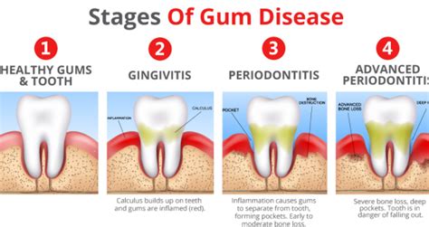 Can you get periodontitis at 25?