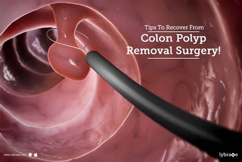 Can you get rid of colon polyps without surgery?