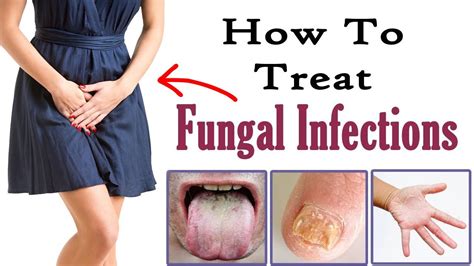 Can you get rid of fungus permanently?