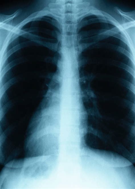 Can you get rid of mold in your lungs?