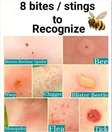 Can you get symptoms of a bee sting days later?