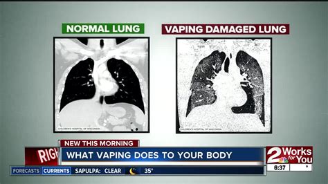 Can you get water in lungs from vaping?