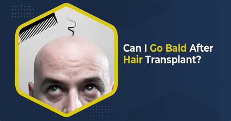 Can you go bald after 40?