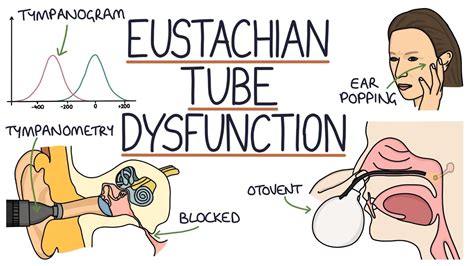 Can you go deaf from Eustachian tube dysfunction?
