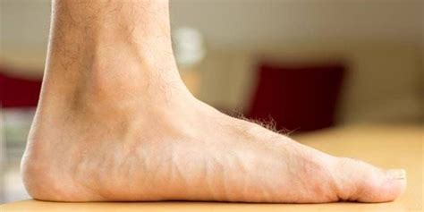 Can you have EDS without flat feet?