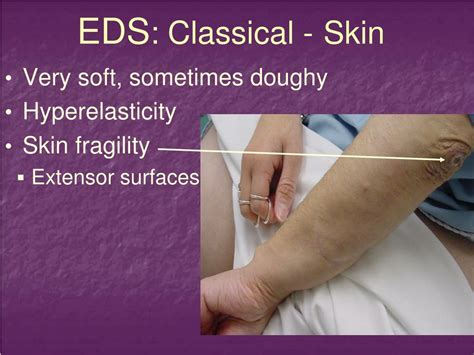 Can you have EDS without stretchy skin?