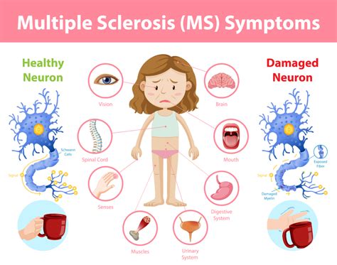 Can you have MS symptoms everyday?