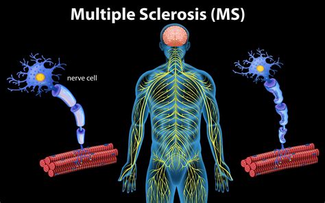 Can you have MS without demyelination?