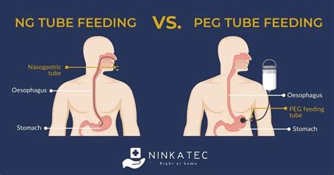 Can you have a feeding tube long-term?