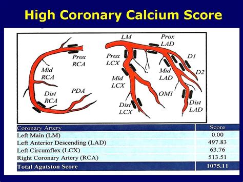 Can you have a high calcium score but no blockage?